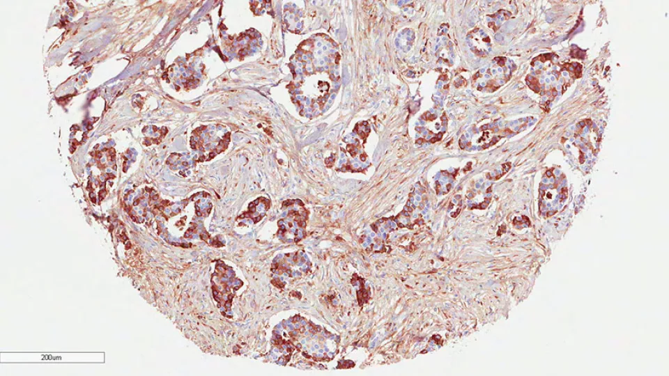  High expression of COMP in breast cancer cells, seen here in brown, is associated with poor clinical prognosis for the patient. Cancer cells expressing COMP become more invasive and change their metabolism, which allows them to survive better and spread 