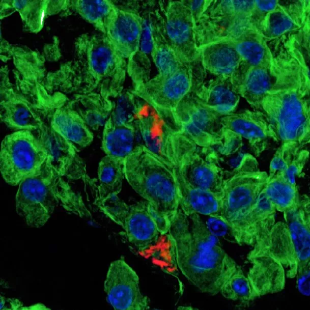 Confocal microscopy image showing nanoparticle uptake (red) in lung tumor cells (blue: nuclei, green: cytoskeleton)