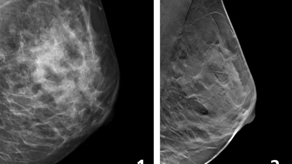 Two mammography images of a breast