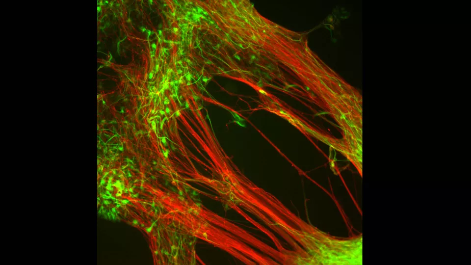 Dopamine-producing neurons that researchers from Lund University have grown in the laboratory from human embryonic stem cells. Photo: Agnete Kirkeby.