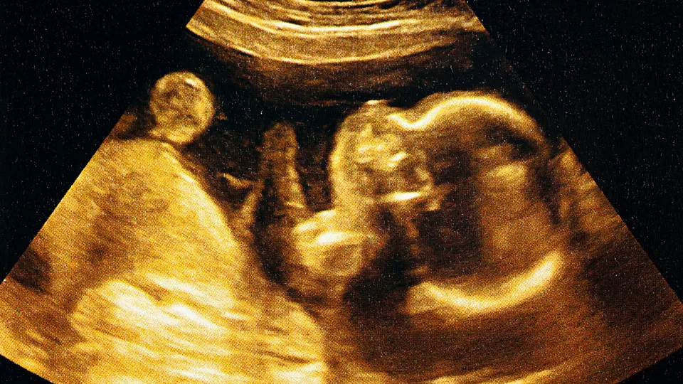 scan image of fetus 