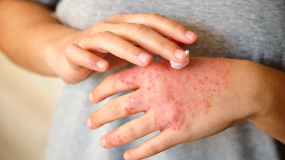 Woman applying ointment or moisturizing cream in the eczema, atopic dermatitis. Photo: iStock
