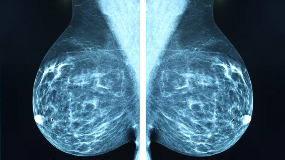 Breast cancer scanning picture. Photo: iStock