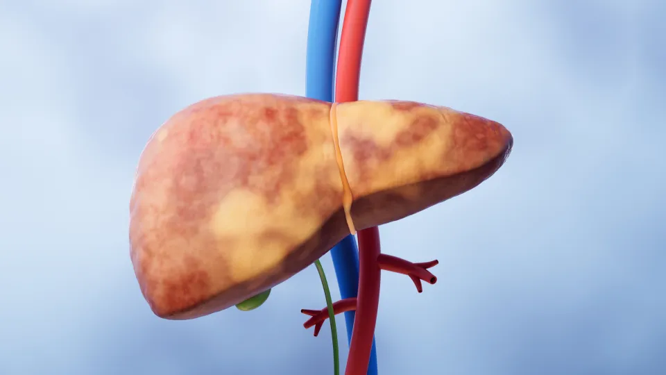 Fatty liver, illustration. Photo: iStock