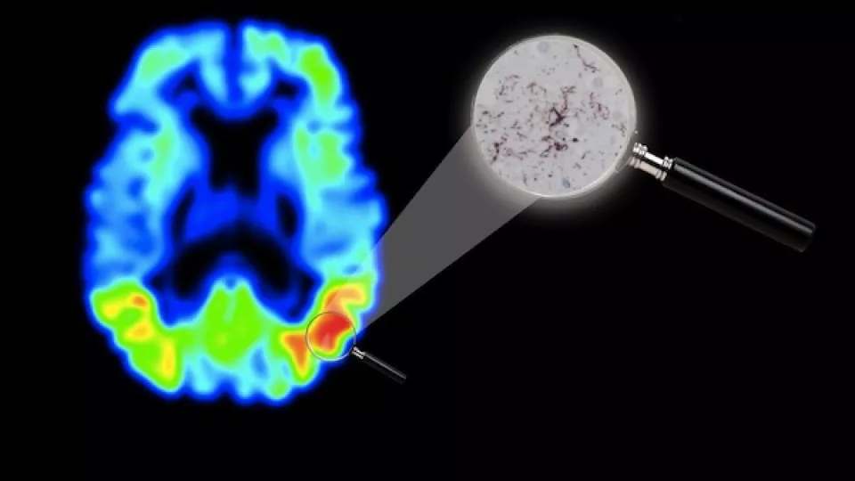 The brain of an Alzheimer’s patient in a tau PET image. Red indicates the areas with the highest concentration of the tau protein. In the magnifying glass, a microscope enlargement showing the dark red streaks and islands of tau. Illustration: Michael Sch