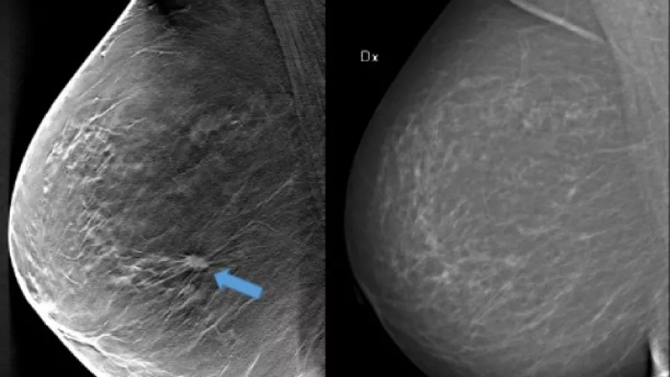 Image of 3D mammography next to 2D mammography