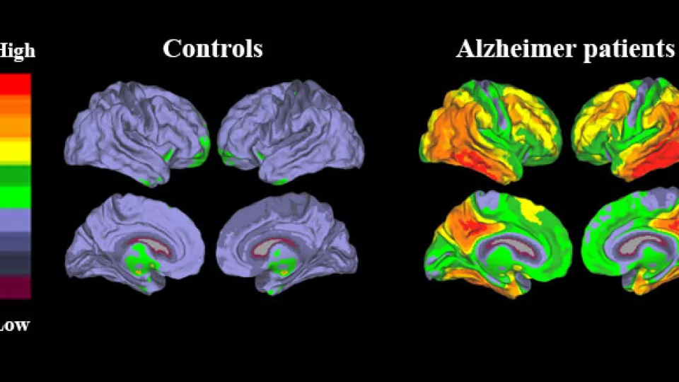 Tau PET imaging shows substantial levels of tau pathology in temporal and parietal regions in patients with Alzheimer’s disease. (Image: Oskar Hansson)