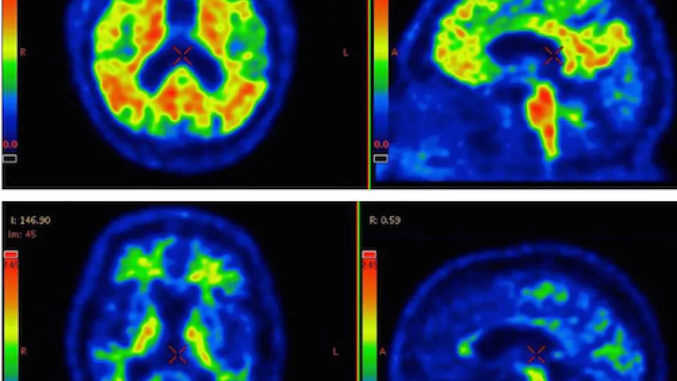 The illuminated areas in the brain (red, yellow and green) indicate an accumulation of the protein beta-amyloid. The top row shows the brain of a patient diagnosed with the Alzheimer’s disease, and bottom row shows the brain of a healthy person. There is 