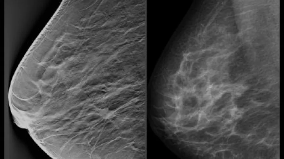 Tomosynthesis vs mammography