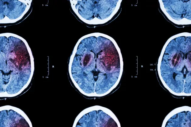 Researchers have succeeded in restoring lost brain function in mouse models of stroke (Image: iStock)