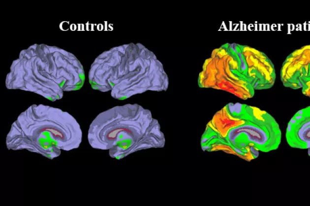 Tau PET imaging shows substantial levels of tau pathology in temporal and parietal regions in patients with Alzheimer’s disease. (Image: Oskar Hansson)