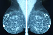 A mammography screening image. Photo: iStock 