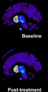 PET image illustrating the dopamine transporter binding signal before and approx 4 month after treatment. The white colour shows a higher signal intensity.